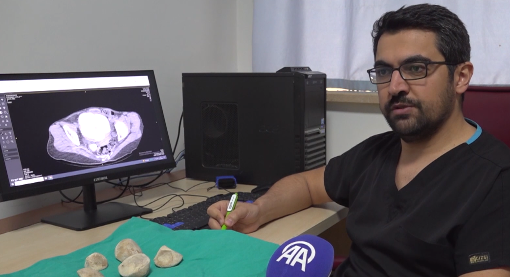 İdrar kanalı ve mesanesinden yarım kilogram ağırlığında 6 taş çıkarıldı