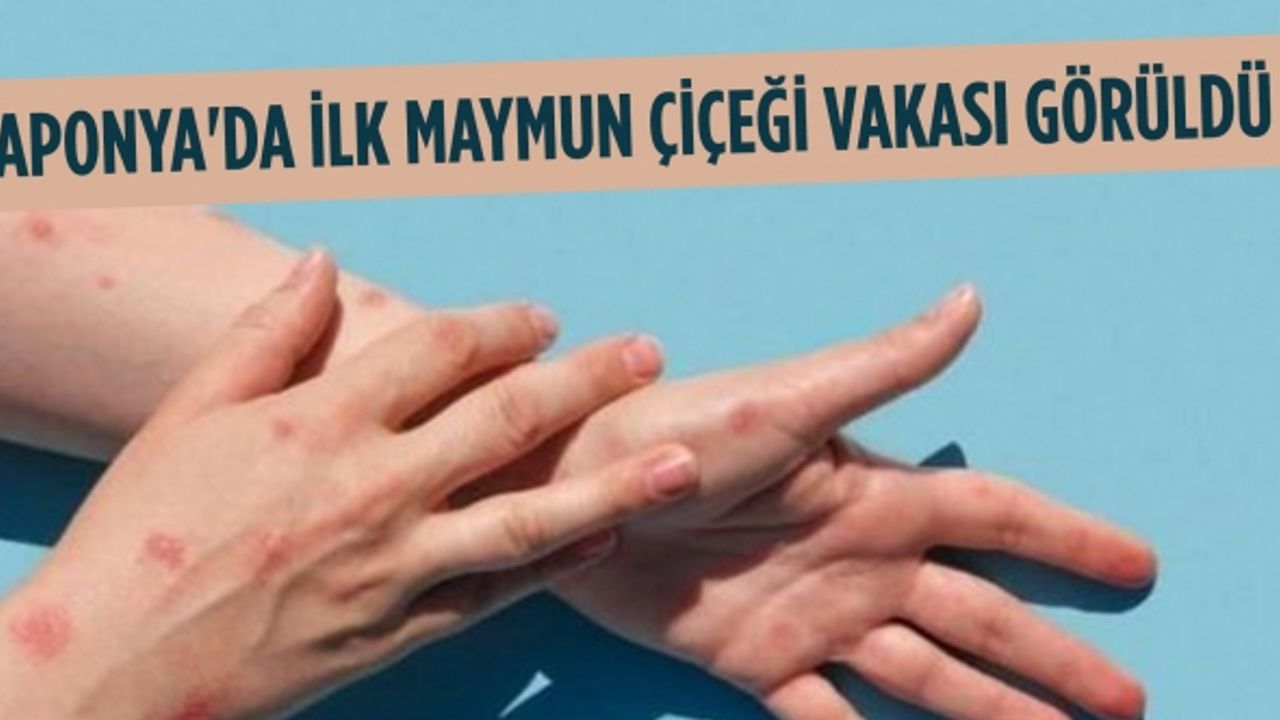 Japonya'da ilk Maymun Çiçeği vakası görüldü