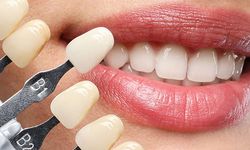 Estetik ve Dayanıklı Gülüşler İçin Zirkonyum ve Porselen Kaplama Rehberi