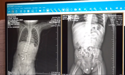 1,5 yaşındaki çocuğun bağırsağından 3 mıknatıs çıkarıldı