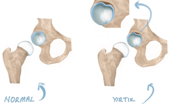 Kalça Labrum Yırtığı: Ağrının Görünmeyen Nedeni ve İyileşme Yolculuğu