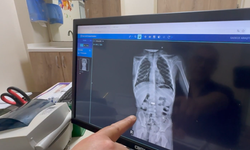 Tuvaletini yapamayan çocuğun bağırsağından iki mıknatıs çıkarıldı