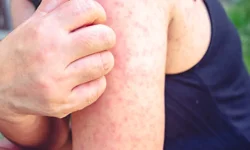 Uzmandan Kritik Uyarı: Bir Kişiden 18 Kişiye Yayılabiliyor!