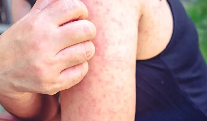 Uzmandan Kritik Uyarı: Bir Kişiden 18 Kişiye Yayılabiliyor!