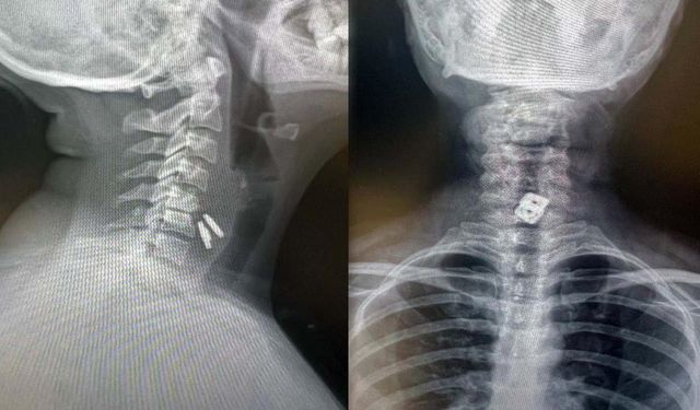 Boynuna takılan metalik disk yemek borusunu delerek midesine indi