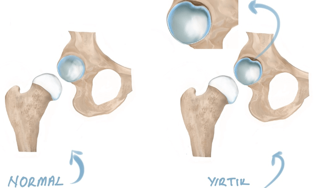 Kalça Labrum Yırtığı: Ağrının Görünmeyen Nedeni ve İyileşme Yolculuğu