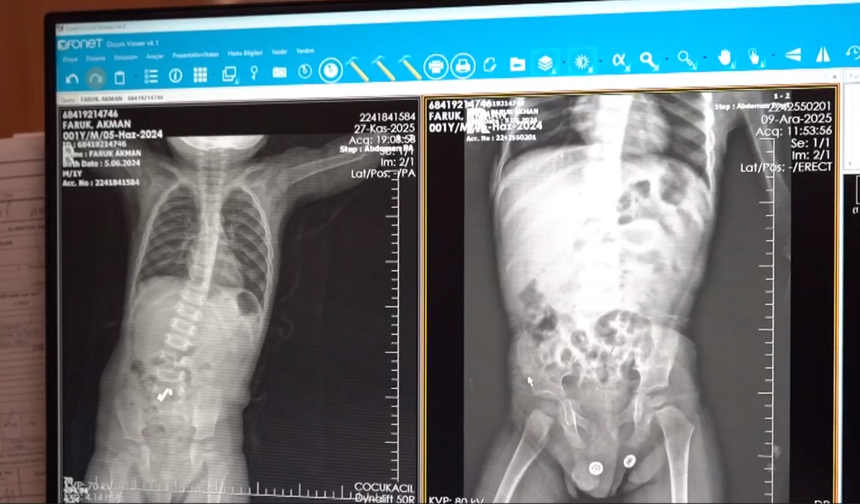 1,5 yaşındaki çocuğun bağırsağından 3 mıknatıs çıkarıldı